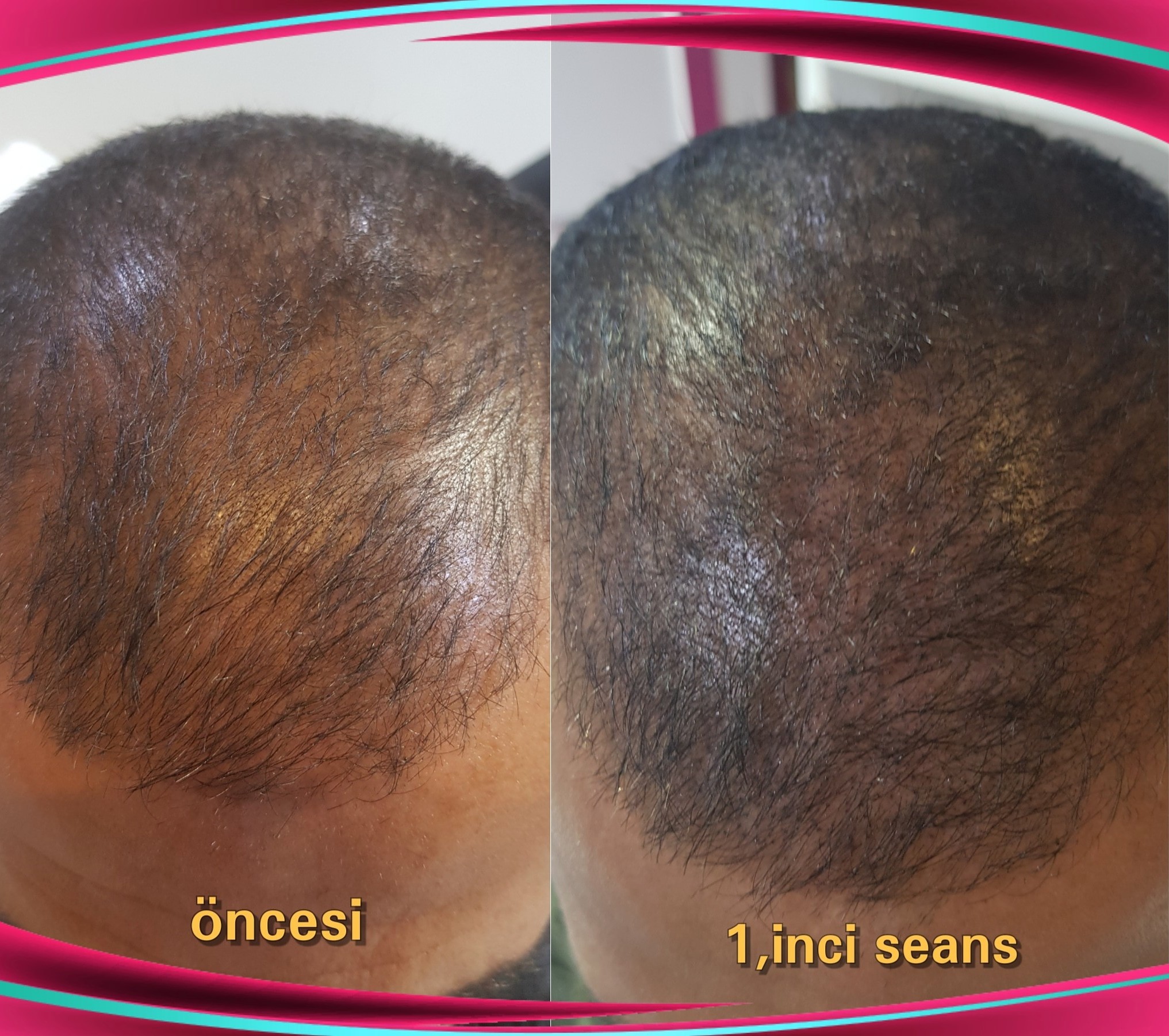 scalp-pigmentasyon-uygulama